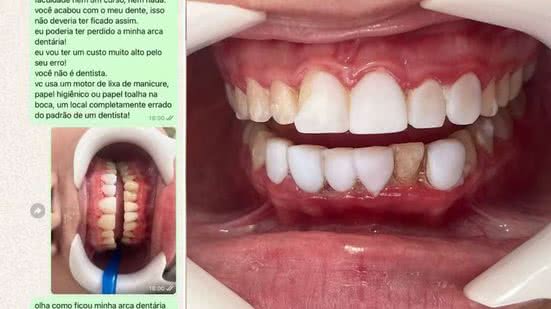 Foto mostra os dentes de adolescente durante a remoção das lentes colocadas por mulher que não é dentista - Imagem: Reprodução | Acervo